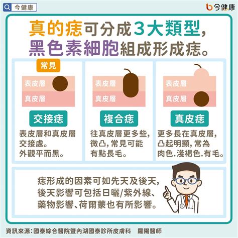 為什麼痣會長毛|痣是什麼？一次了解痣原因、就醫時機以及如何改善